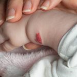 hemangiomas 768x512 1