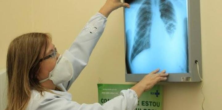 Dia Nacional de Combate à Tuberculose: SES-AM esclarece sobre meios de prevenção, sintomas e tratamento Portal Informe Digital WhatsApp Image 2023 11 17 at 14.47.01